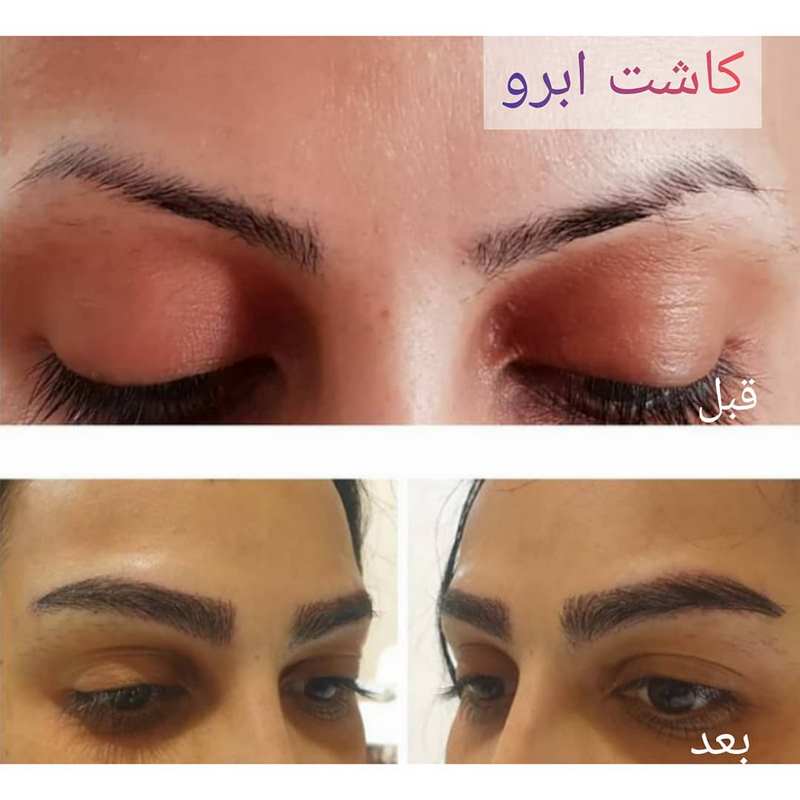 گالری فیلم کاشت ابرو